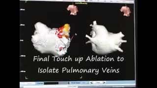 Atrial Fibrillation Ablation part 3 of 3 How to Perform Pulmonary Vein Isolation [upl. by Lamhaj968]