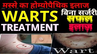 homeopathic treatment for warts and migraine live case taking drrajeshmanghnaniwwwehomeovision [upl. by Akienat]