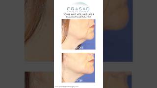 How Treatment for Jowls can be Done with Filler jowls [upl. by Islaen]