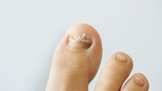 How to prevent and treat nail fungus [upl. by Anilac]