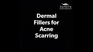 Dermal Fillers to Remove Acne Scars [upl. by Ybot]