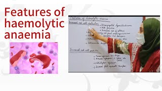 Features of haemolytic anaemia [upl. by Ahseym]