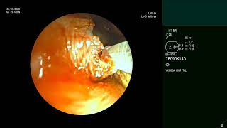 Adenoid cystic carcinoma of Trachea  Silicone Y stent  Complications Bronchoscopic management [upl. by Ariuqahs]