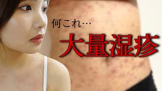 【閲覧注意】突如全身に現れた大量の湿疹。診断結果出ました。 [upl. by Aehc]