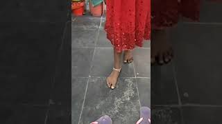 Foot drop High stepping gait [upl. by Enirahtak]