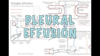 Pleural Effusion DETAILED  pathophysiology signs and symptoms treatment [upl. by Ennoved]