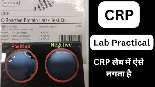 CRP Test Procedure in Hindi  CReactive Protein  Latex Test Procedure labtechnician mlt dmlt [upl. by Nella]