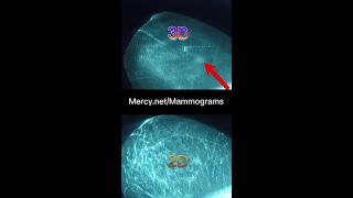 2D v 3D Mammograms [upl. by Brodsky167]