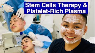 GoodBye Acne ScarsStem Cells Therapy and PlateletRich Plasma [upl. by Ariayek]