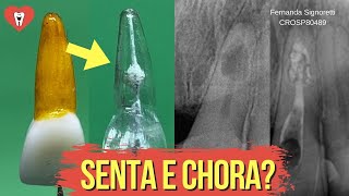 ENDODONTIA EM REABSORÇÃO INTERNA  PASSO A PASSO  Endolovers [upl. by Cynth]