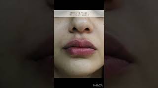 Lip Filler Before and After Compilation  LIP FILLER drjyotiguptadermatologist7266 Lip Injections [upl. by Niwde]