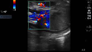 Case 1  Epididymo orchitis clip 2 [upl. by Georas]