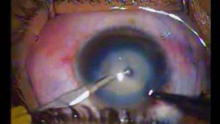 Cataract Surgery Video [upl. by Chelsae]