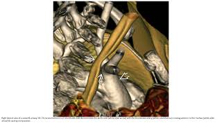 Innominate Artery Compression Syndrome Imaging [upl. by Hilar383]