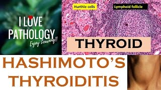 HASHIMOTOS THYROIDITIS Etiopathogenesis Morphology amp Complications [upl. by Liliane521]