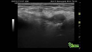 Bursitis PES Anserina [upl. by Rea852]