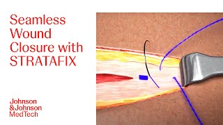 StepbyStep Guide to Wound Closure using STRATAFIX in Open Surgery  JampJ MedTech [upl. by Eanad]