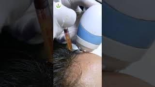 Quick Guide to PRP Therapy Process For Hair Loss at Care Well Medical Centre shorts [upl. by Yule]