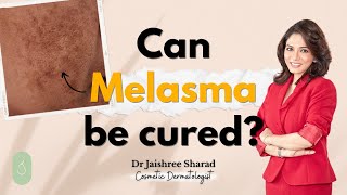 Can melasma be cured  Dr Jaishree Sharad [upl. by Anelleh]