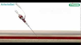 ArterioSel  Safe Simple Successful Arterial Cannulation [upl. by Pavier]