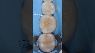 Class I Direct Composite Restorations Cusp by Cusp Buildup adhesivedentistry [upl. by Gabrielle]