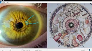 Iridology Lesson  Iris Reading 10 [upl. by Patrica]