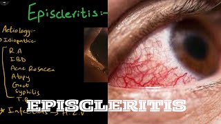 Episcleritis  Aetiology  pathogenesis  clinical features  treatment [upl. by Bertila]