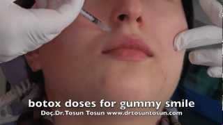 botox doses for gummy smile [upl. by Salomo365]