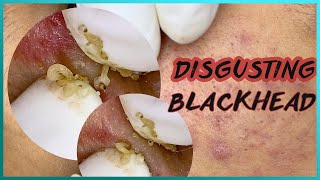 Big Cystic Acne Blackheads Extraction Blackheads amp Milia Whiteheads Removal Pimple Popping [upl. by Nniw]