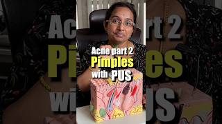 How To Treat Pus Filled Acne At Home  Papules amp Pustules trending [upl. by Jankell884]