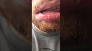 ORAL THRUSH  Candidiasis or yeast infection Angular cheilitis © [upl. by Polinski]