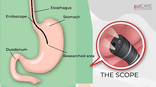 Preparing For Your Gastroscopy OGD  GUTCARE [upl. by Arag]