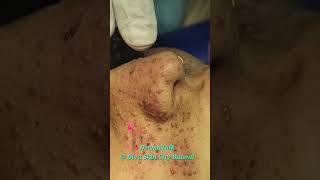 Facial Angiofibromas Removal with CO2 Laser [upl. by Aronel]