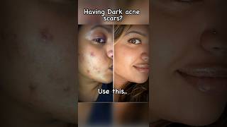 Dark acne scars remedy Adaferin gel viral skincare acnescars trending beauty acneremedy skin [upl. by Stallworth]