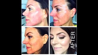 TCA CHEMICAL PEEL 25  Application Tutorial [upl. by Eerb]