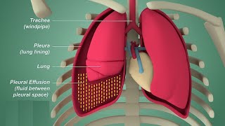 Pleural effusion  Internal medicine Etiology Clinical Features Diagnosis and Treatment Usmle [upl. by Llewol905]