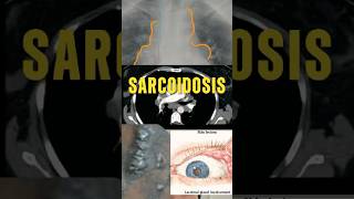 SARCOIDOSIS  CASO CLÍNICO MedicinaMedEdMédicoSaludRadiologíaCasoClínicoEducaciónMédica [upl. by Beverly]