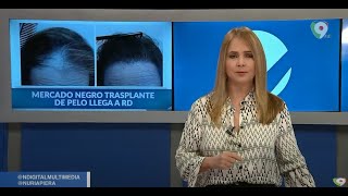 Mercado Negro Trasplante de Pelo llega a RD  Nuria Piera [upl. by Enelyak57]