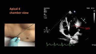 Standard views for a basic echocardiogram [upl. by Miarzim]