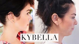 My Kybella Experience [upl. by Norac265]