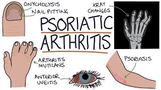 Psoriatic Arthritis [upl. by Scully]