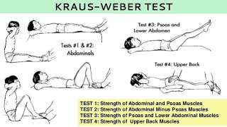 Kraus–Weber test unit 6kraus weber test in hindi [upl. by Ballou]