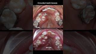 The most crowded teeth ive ever seen braces orthodontist dentist [upl. by Hayouqes]