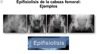 Epifisiolisis de la cabeza del fémur  Ejercicio  Rehabilitación [upl. by Aronle414]