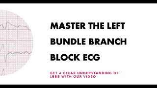 Master the Left Bundle Branch Block ECG Get a clear understanding of LBBB with our video [upl. by Eiznek]