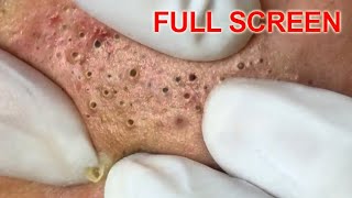 Blackheads removal  Best Pimple Popping Videos [upl. by Cyprio]