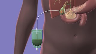 Your Percutaneous Cholecystostomy Drain [upl. by Erusaert]