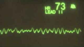 Ventricular Fibrillation  ECG Training Tutorial [upl. by Virge]