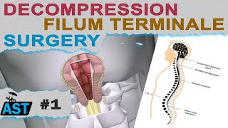 Filum Disease and ACM diagnosis surgeries symptoms info  AST 1 13022024 English [upl. by Latea]