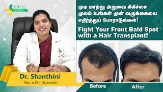 Worried about your hair baldness get our Shan’s hair transplant for appointment8825581472 [upl. by Annawal]